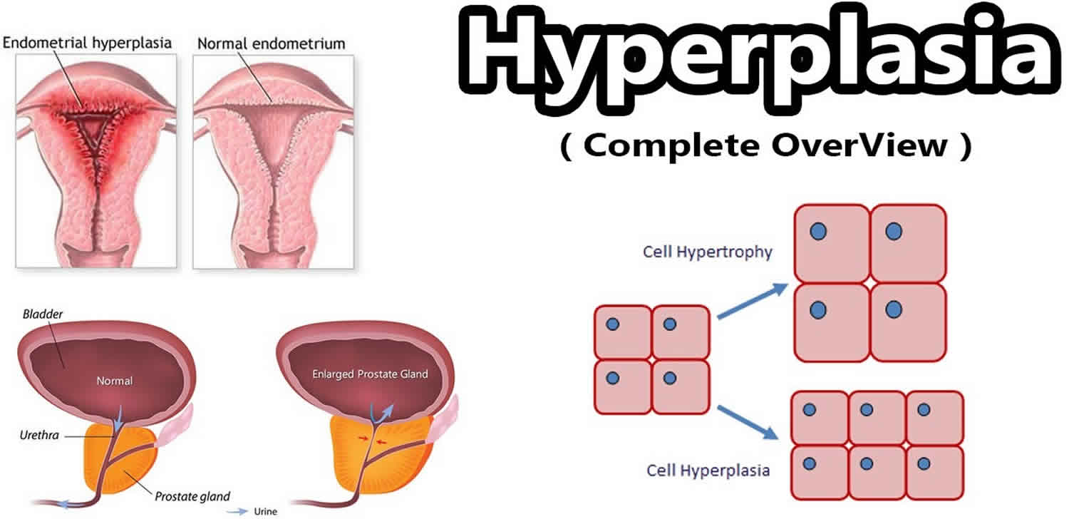 Hyperplasia Definition Congenital Adrenal Endometrial Prostatic 