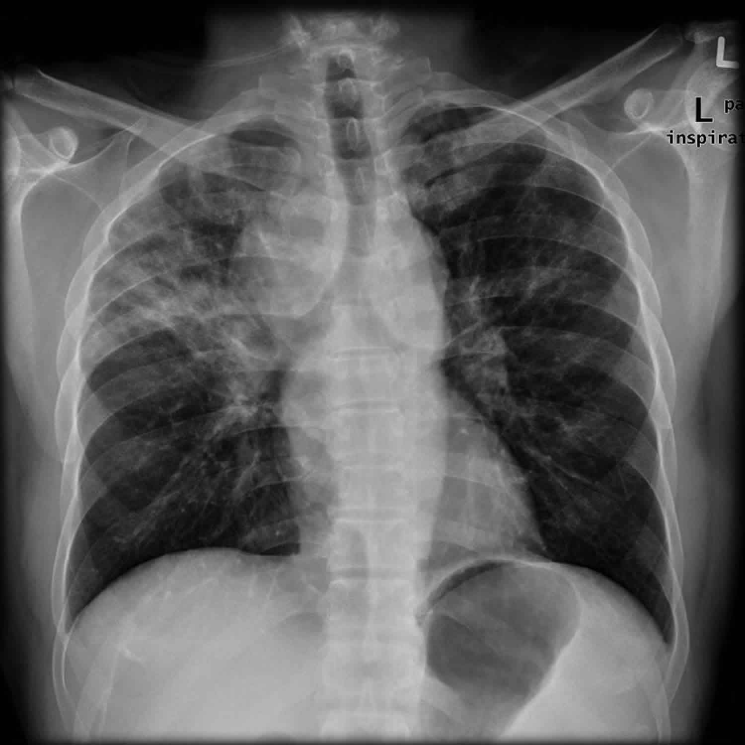 Interstitial lung disease causes, symptoms, stages, diagnosis & treatment