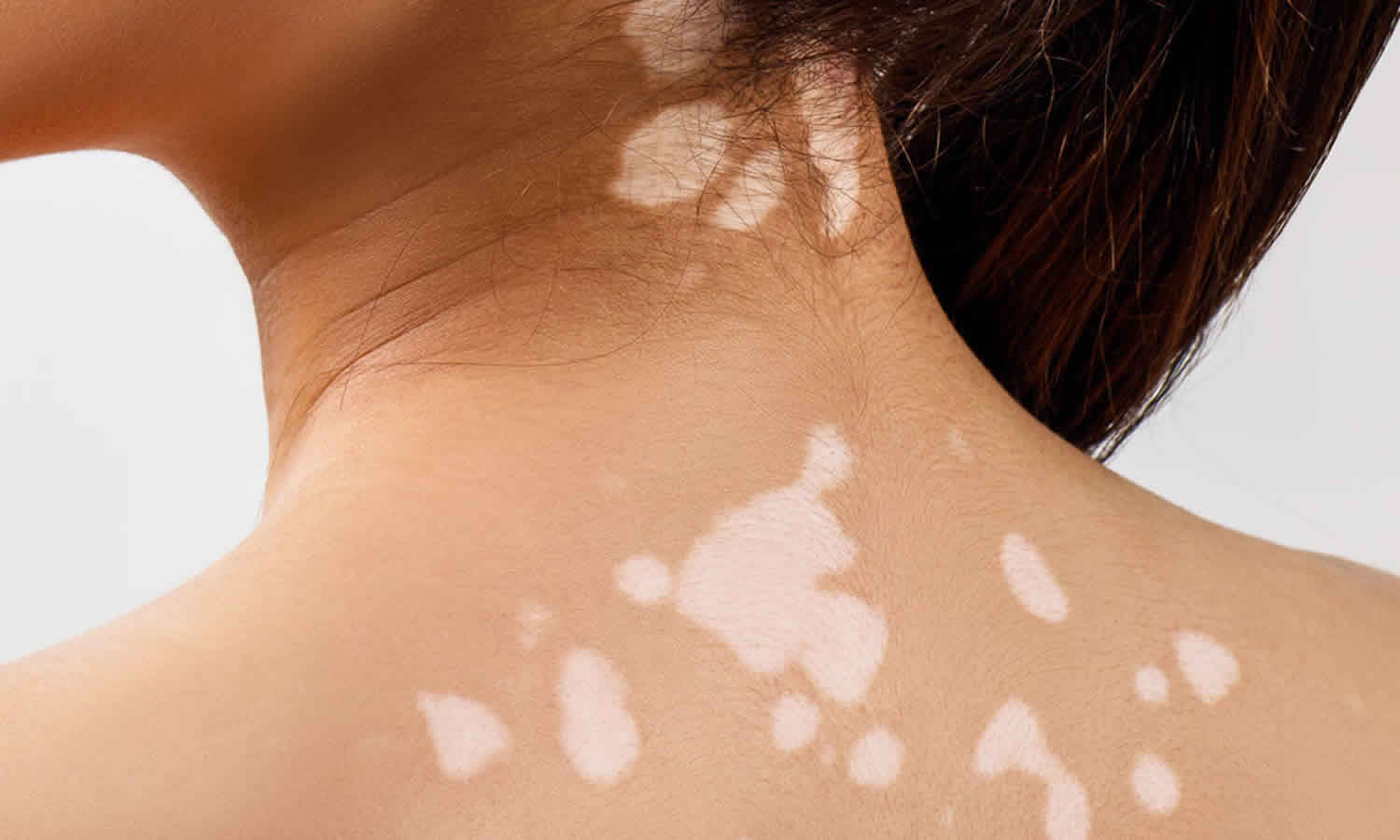 Skin Discoloration Has Many Causes—and Just As Many Treatment Options