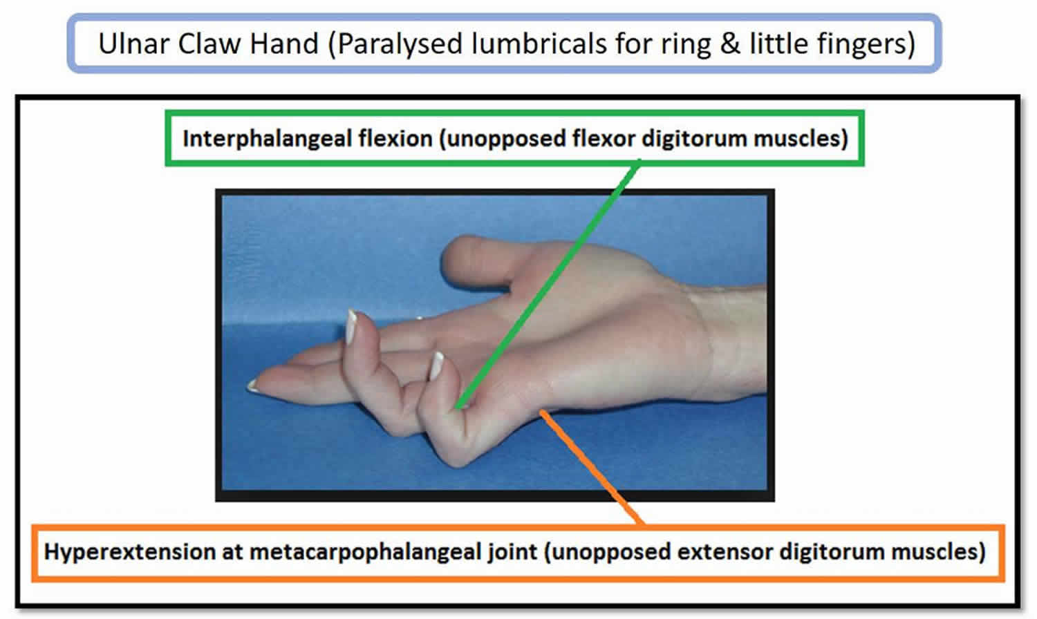 Ulnar Nerve Anatomy Innervation Injury Damage Palsy And Entrapment