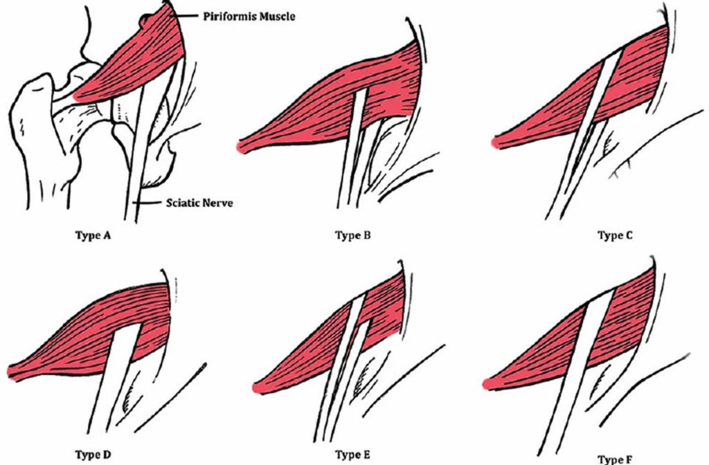 Piriformis Syndrome Causes Symptoms Test Diagnosis Treatment And Stretch