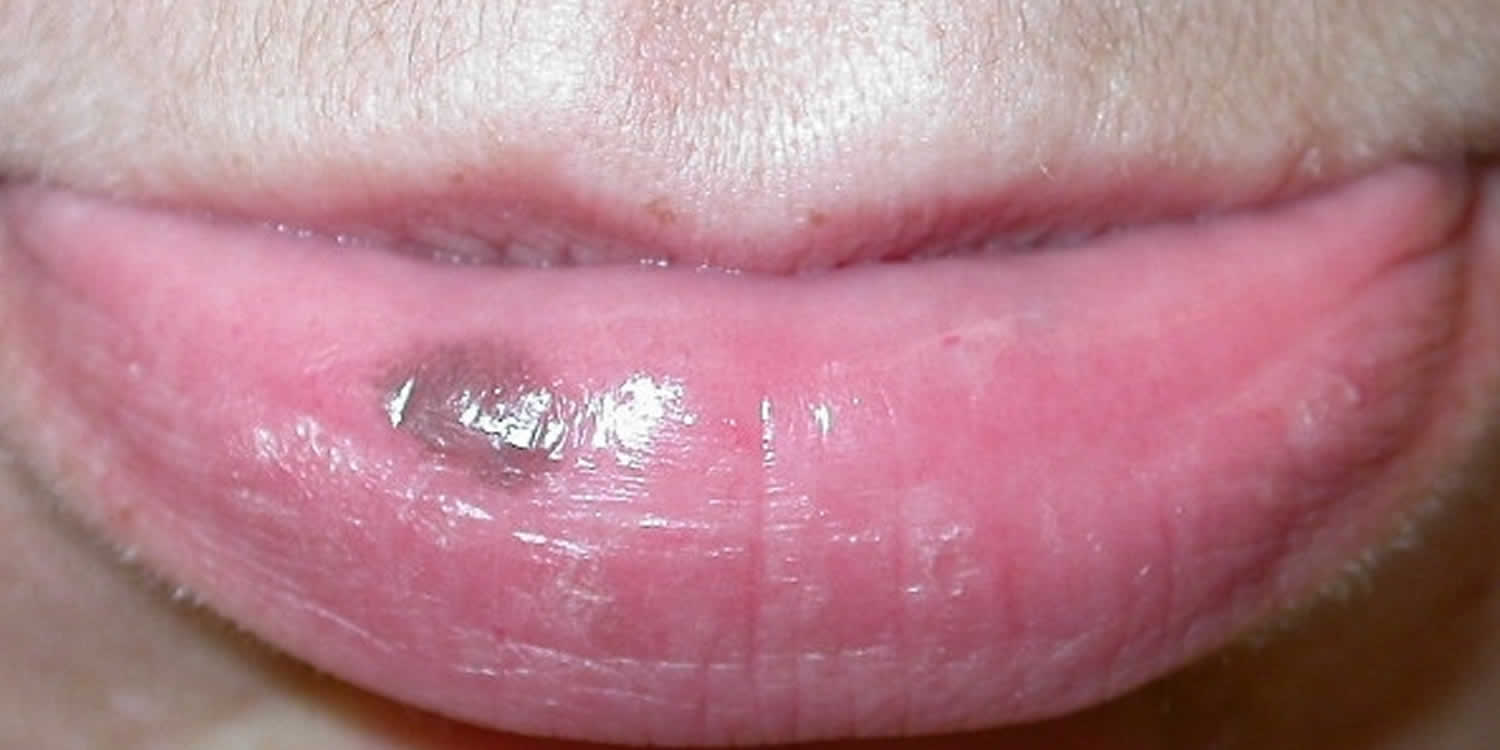 Labial Melanotic Macule Or Oral Melanotic Macule Causes And Treatment   Labial Melanotic Macule 