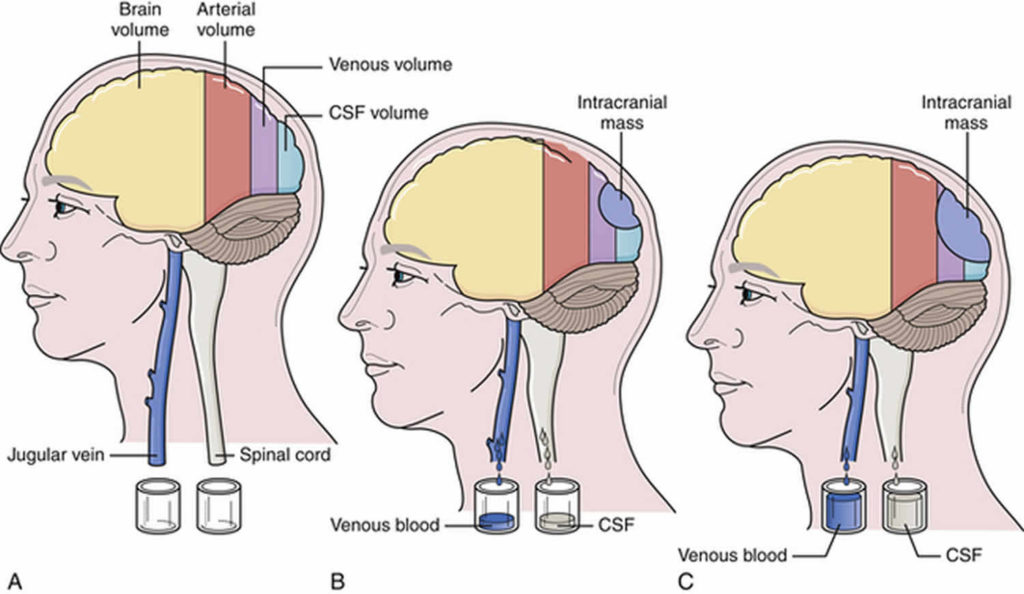 Intracranial Pressure High Intracranial Pressure Causes Symptoms And Treatment 4346