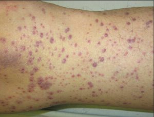 Scurvy Causes, Symptoms, Scurvy Skin Rash, Diagnosis & Scurvy Treatment