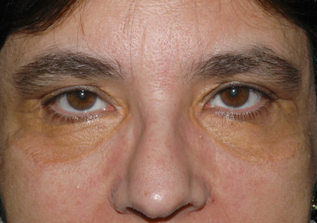 Xanthoma eye, tendinous, tuberous and disseminatum causes & treatment