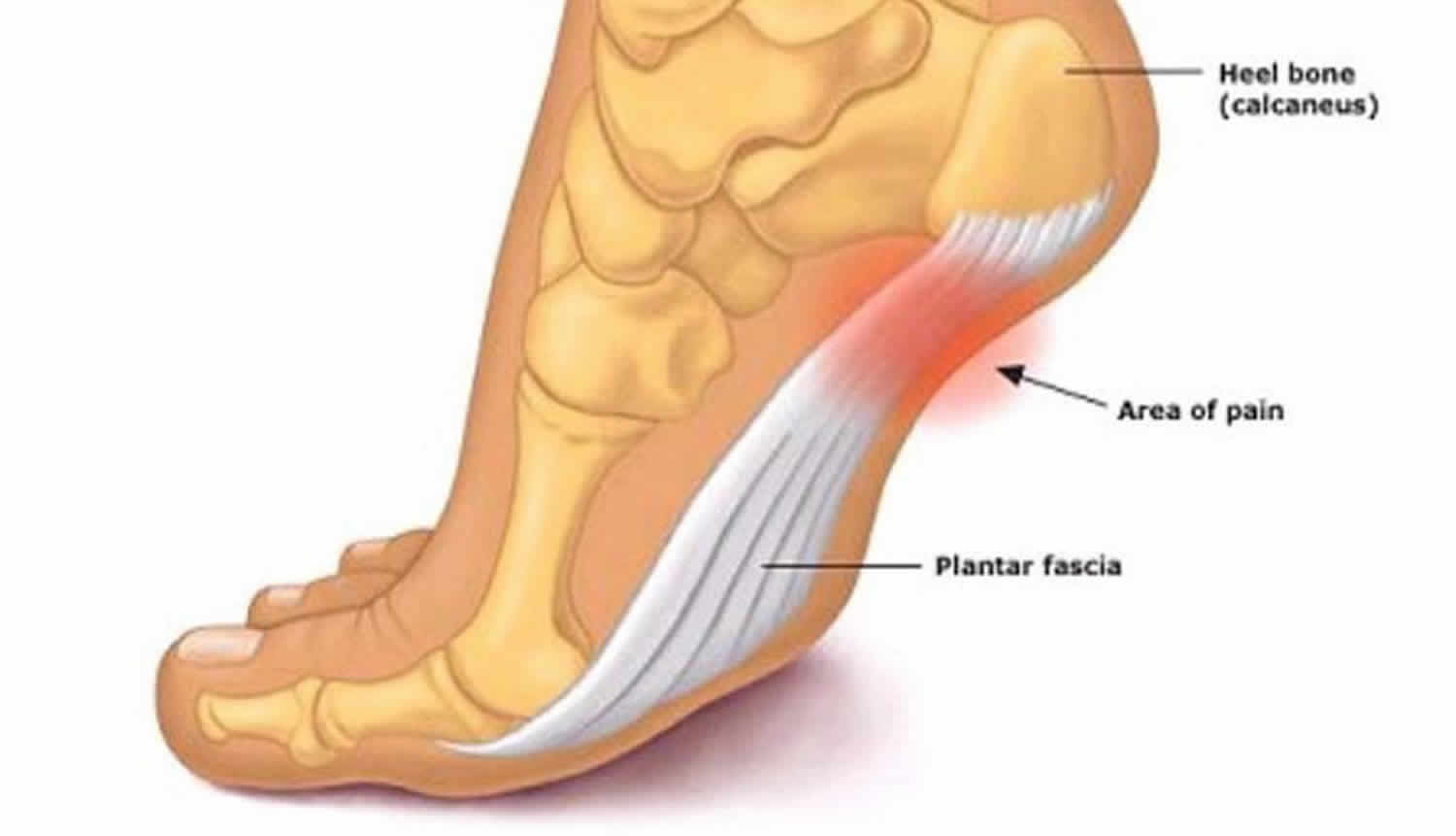 Heel Pain Surgery – Da Vinci Foot & Ankle