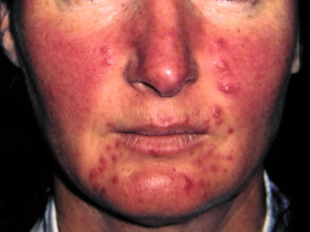 Causes of pustule skin lesions on face, nose, body, hands & feet