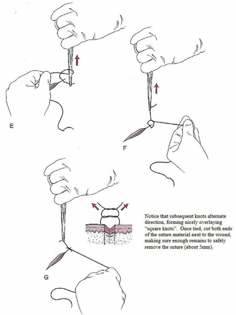 Surgical suture, types of sutures, sizes, how to suture & suture