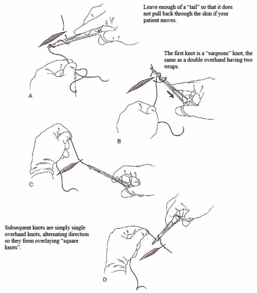 Surgical suture, types of sutures, sizes, how to suture & suture