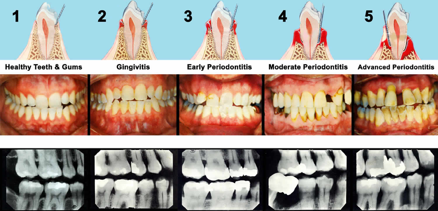 Periodontitis Causes Symptoms Complications Diagnosis Treatment