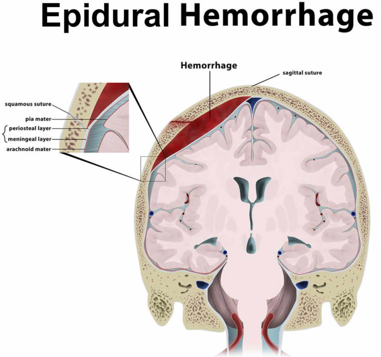 Epidural hematoma causes, signs, symptoms, diagnosis & treatment