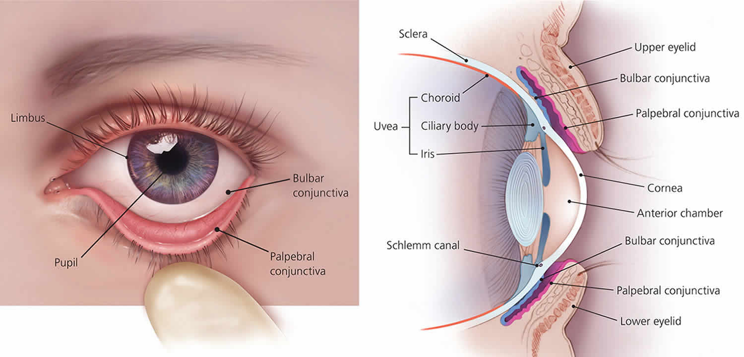 Pinguecula Eye Causes Symptoms Diagnosis Pinguecula Eye Treatment pinguecula-eye-causes-symptoms-diagnosis-pinguecula-eye-treatment