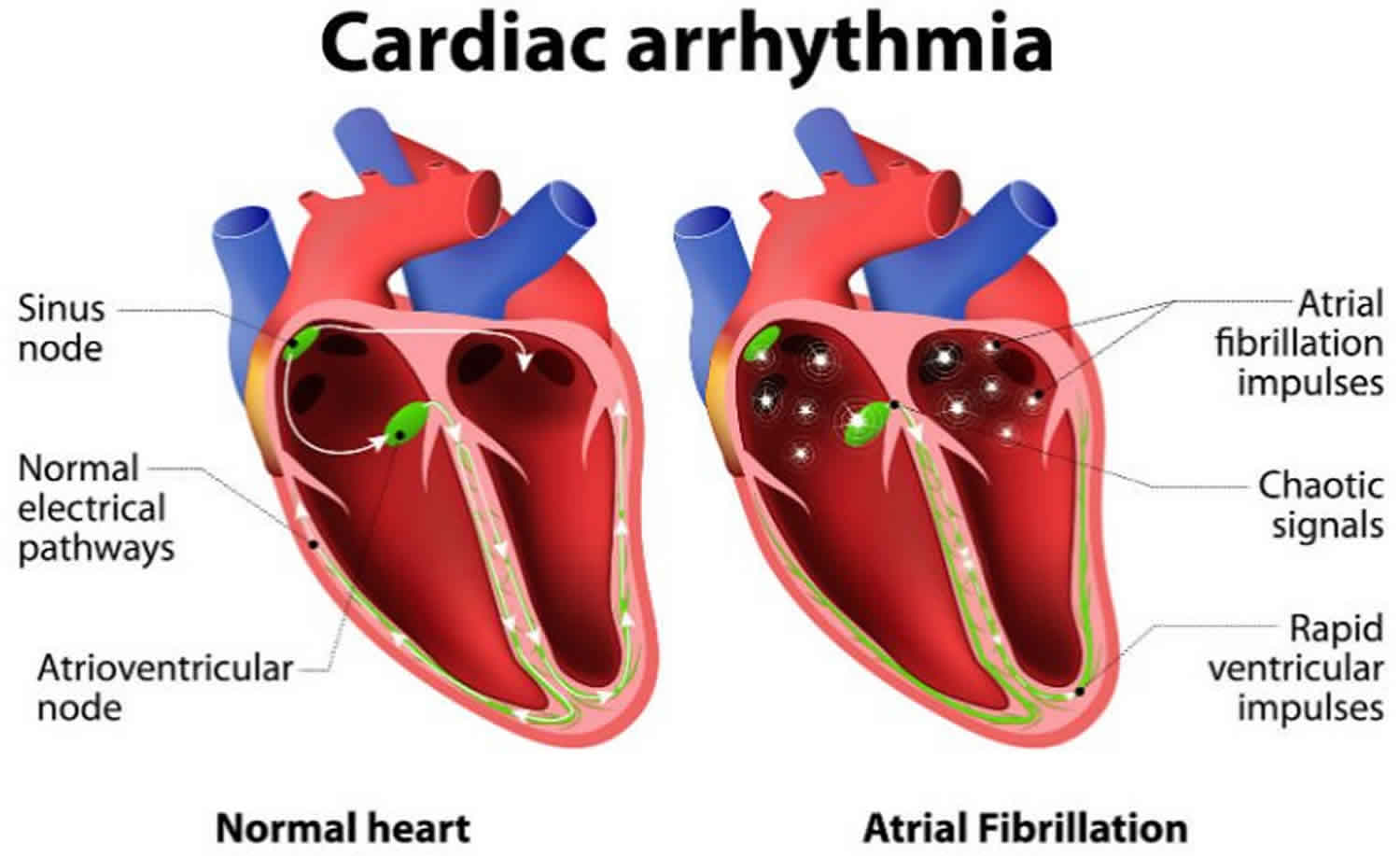 Cardiac dysrhythmia signs and symptoms