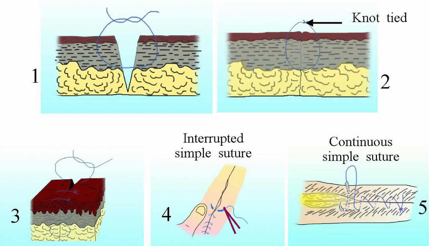 how to suture a wound