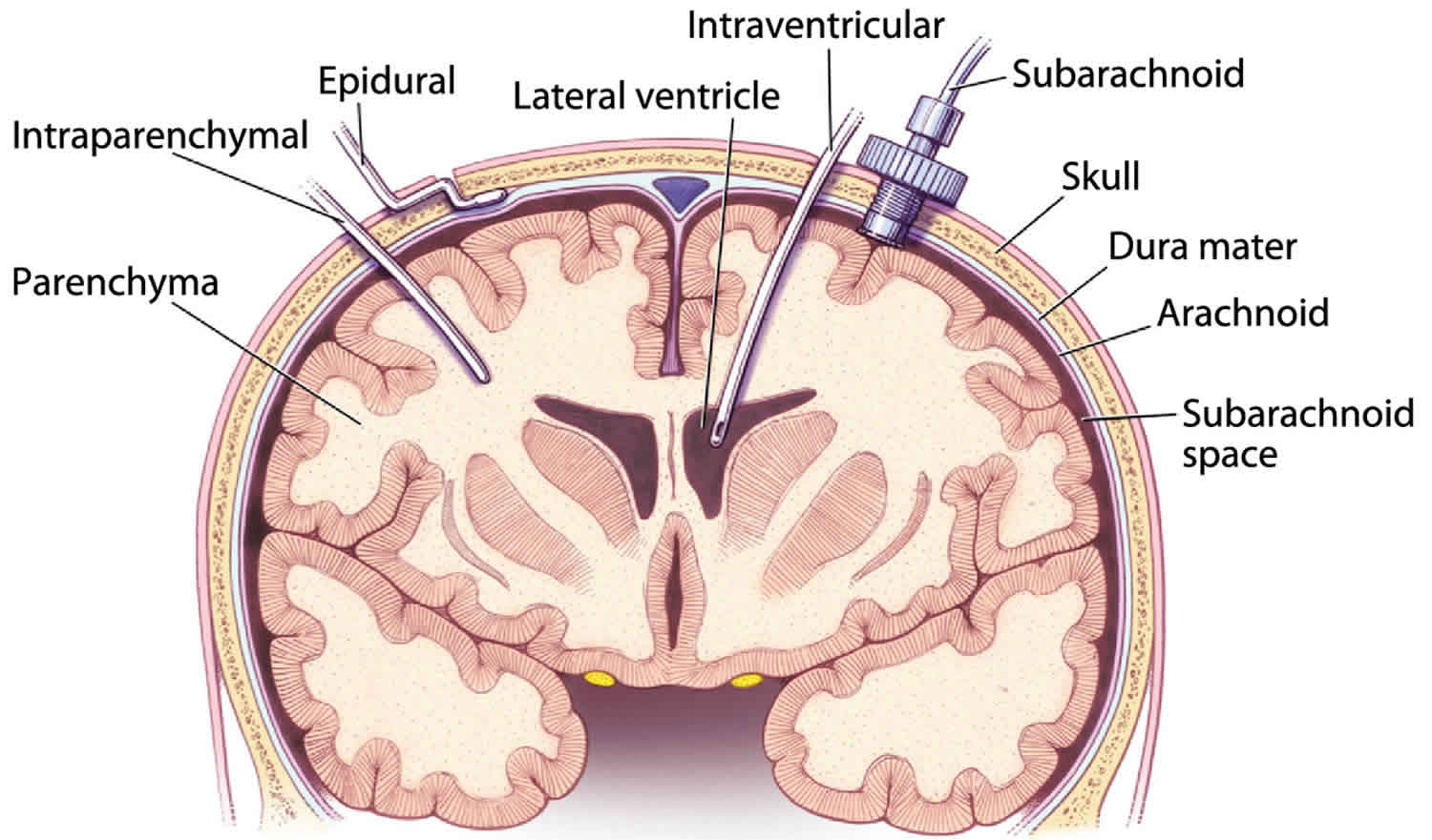 Intracranial Pressure High Intracranial Pressure Causes Symptoms Treatment