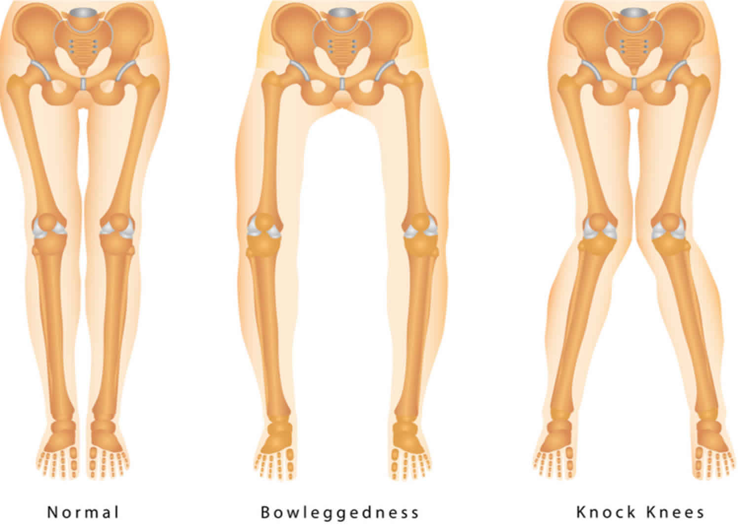 Knock knees causes, signs, symptoms, diagnosis & knock knees treatment