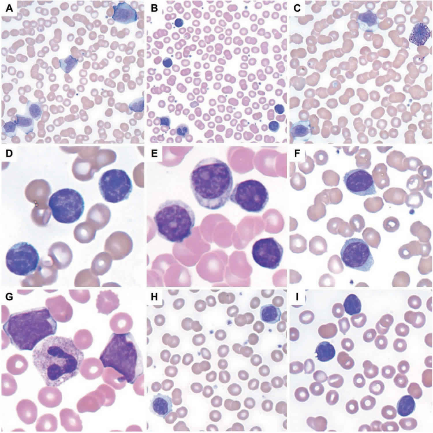 Leukocytosis Definition Causes Symptoms Diagnosis And Leukocytosis Treatment 2892