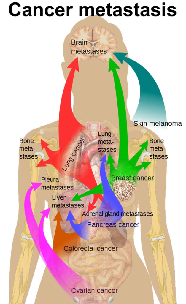Cancer metastasis causes, symptoms and metastasis survival rate