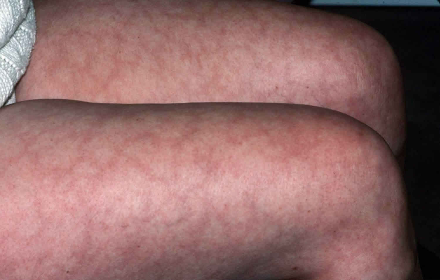 mottled-skin-or-livedo-reticularis-causes-diagnosis-and-treatment