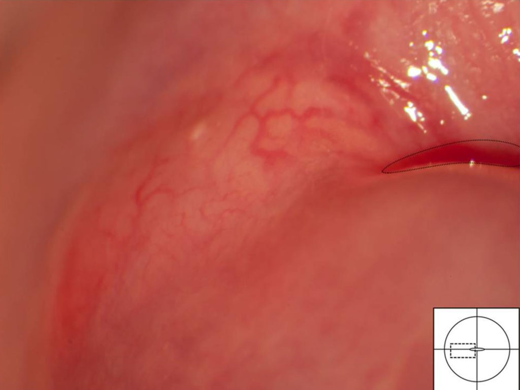 Nabothian Cyst Location