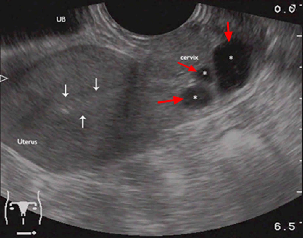 Nabothian Cyst In Cervix Causes, Symptoms & Nabothian Cyst Treatment