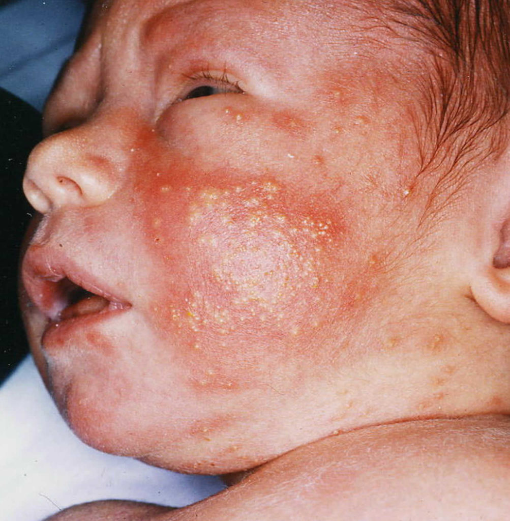 Erythema Toxicum Neonatorum Causes Diagnosis And Erythema Toxicum Treatment