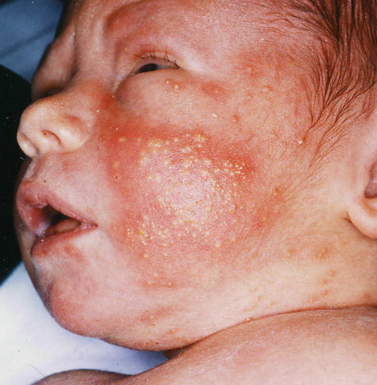 erythema-toxicum-neonatorum-causes-diagnosis-erythema-toxicum-treatment