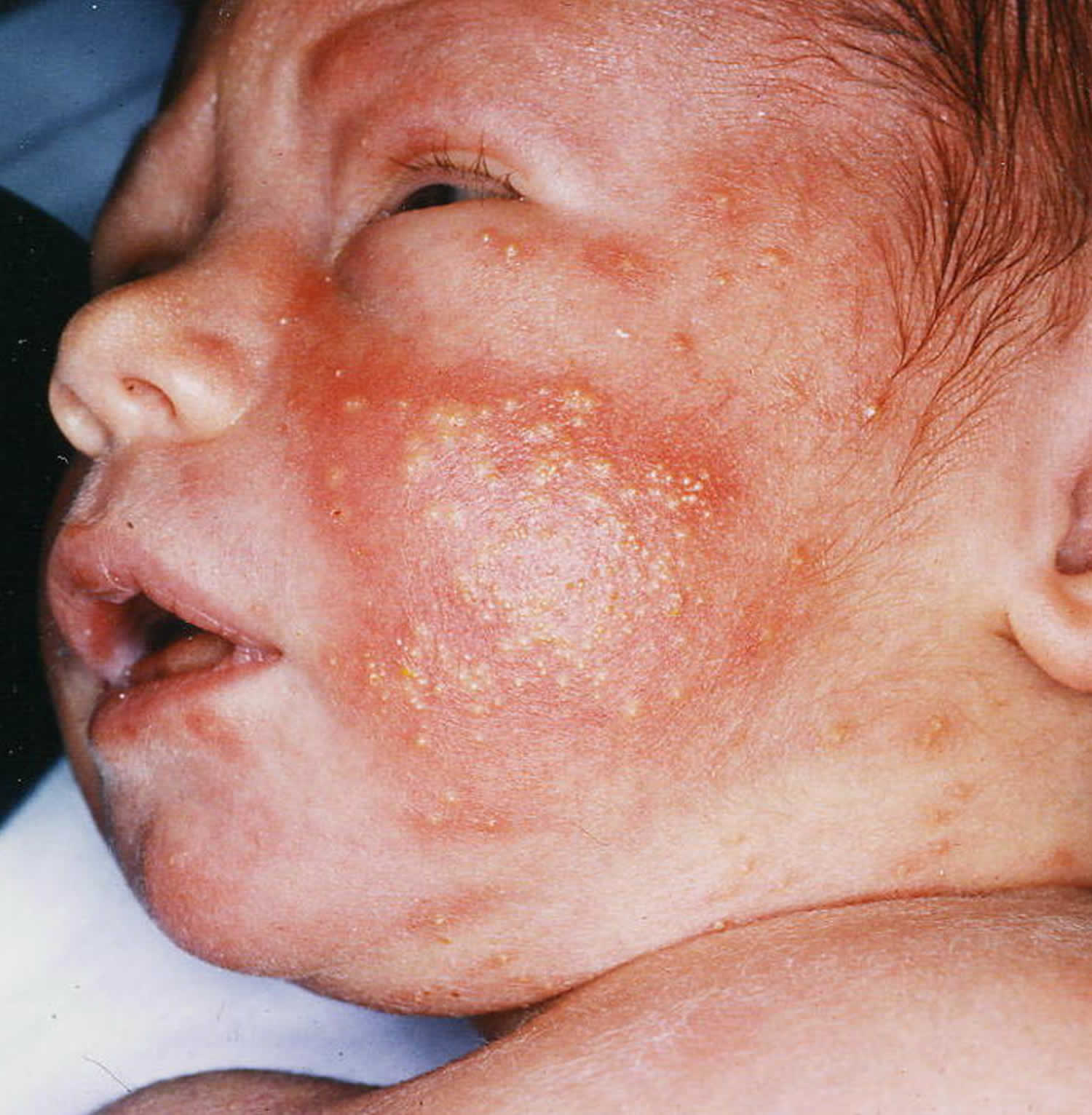 Erythema toxicum neonatorum causes, diagnosis & erythema toxicum treatment