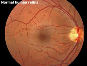 retinitis pigmentosa definition