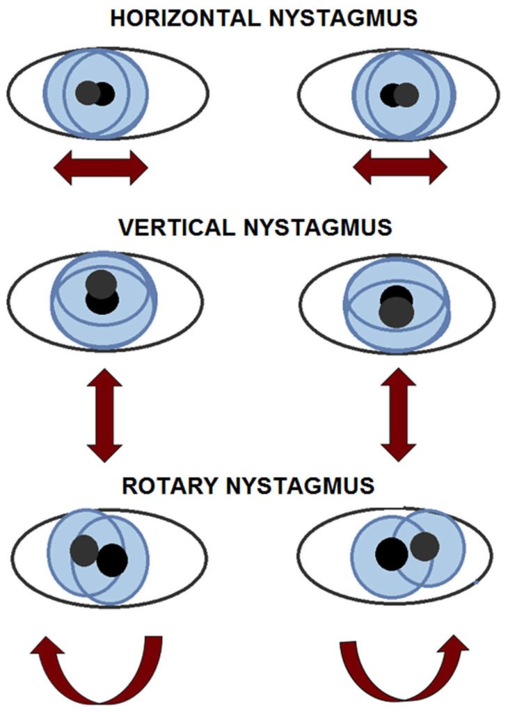 Eye nystagmus causes, types, signs, symptoms, test & nystagmus treatment