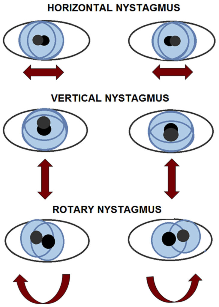 eye-nystagmus-causes-types-signs-symptoms-test-nystagmus-treatment