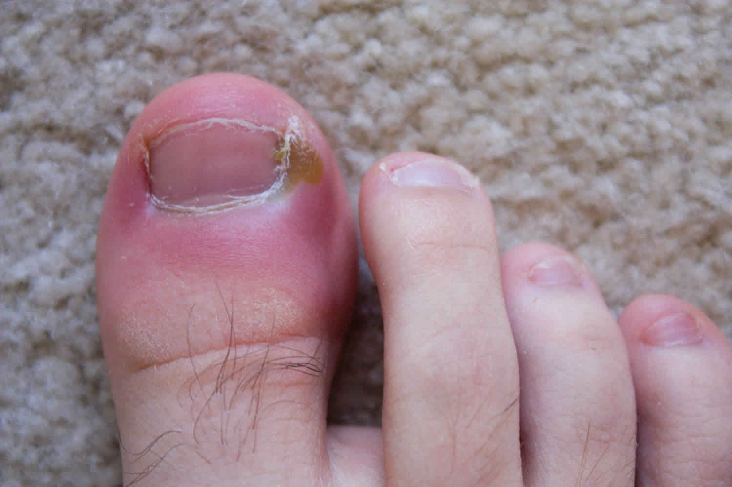 Nail infections: View Causes, Symptoms and Treatments | 1mg