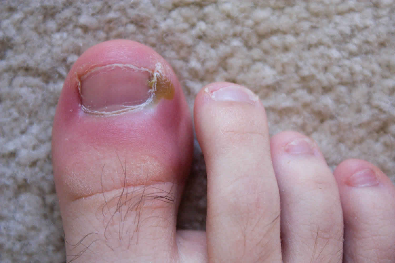 How To Address The Disappearing Nail Bed