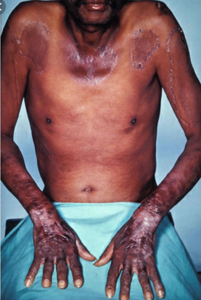 pellagra-causes-pellagra-dermatitis-rash-diagnosis-pellagra-treatment