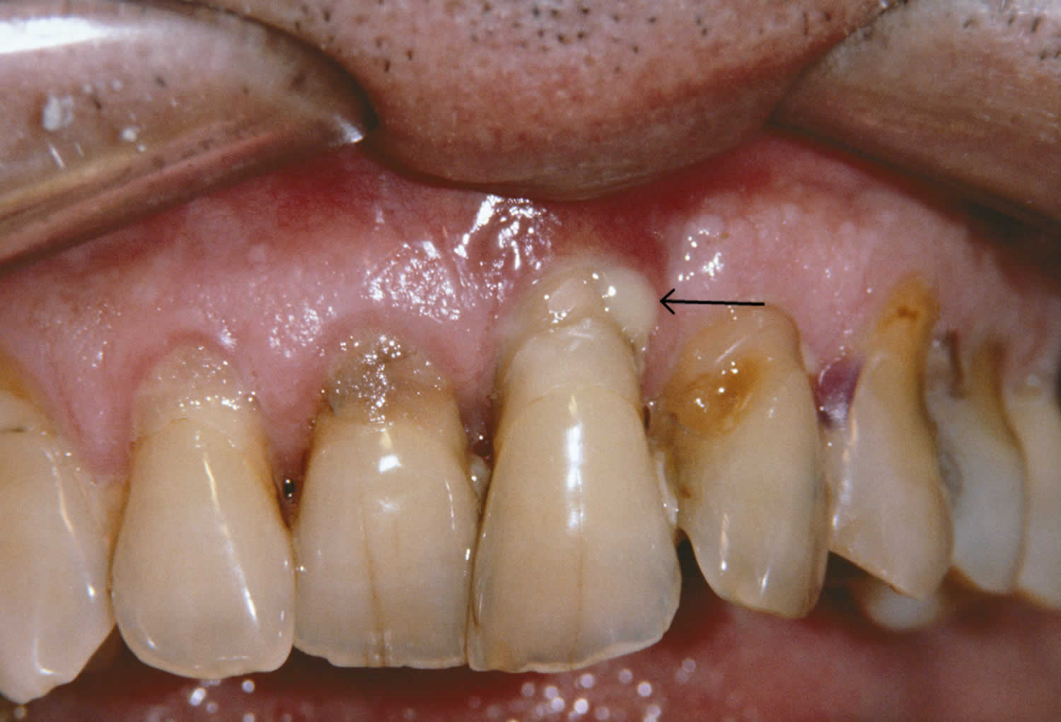 Periodontitis causes, symptoms, complications, diagnosis & treatment