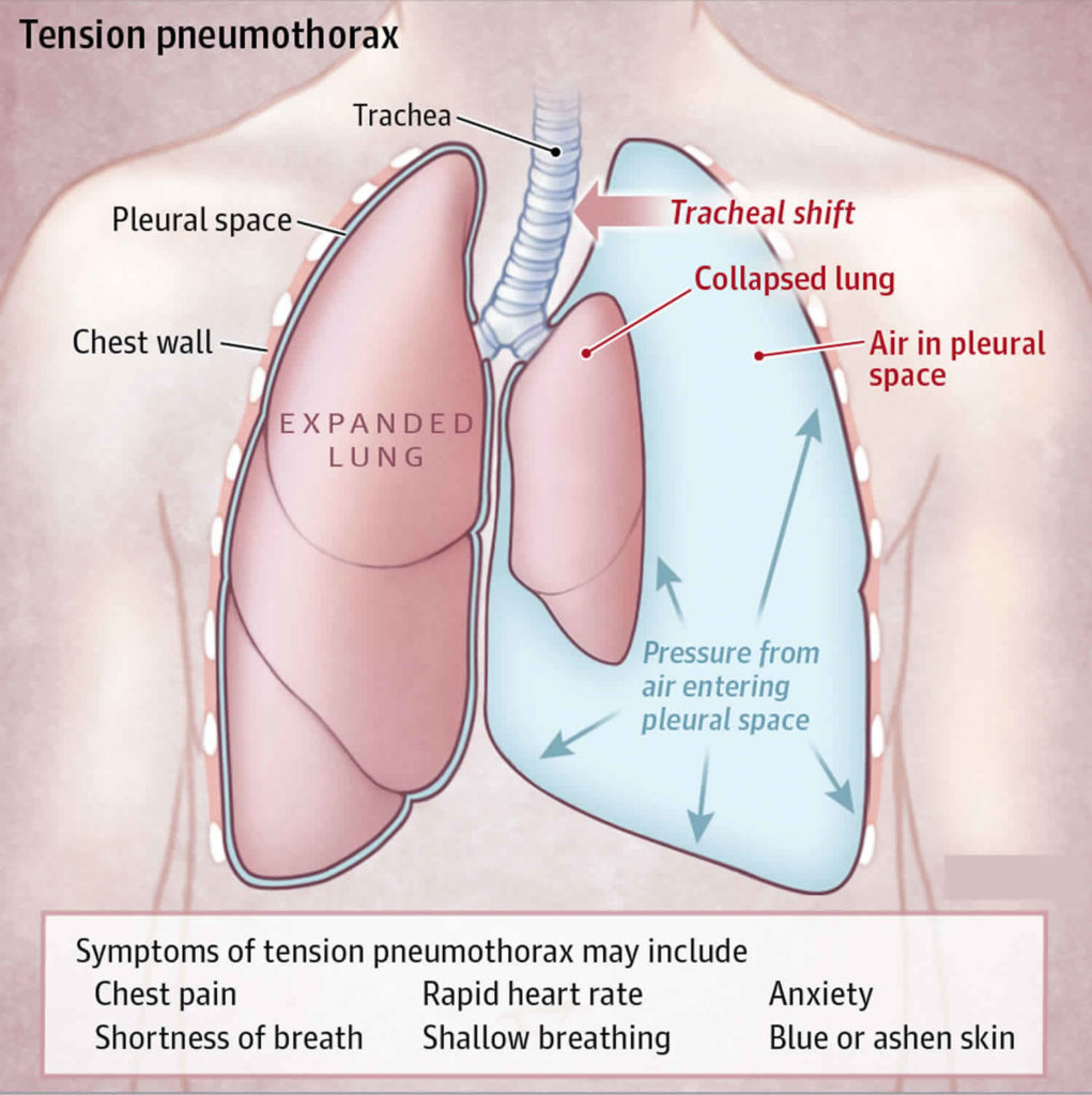 goodpasture-syndrome-disease-of-the-lungs-and-kidneys