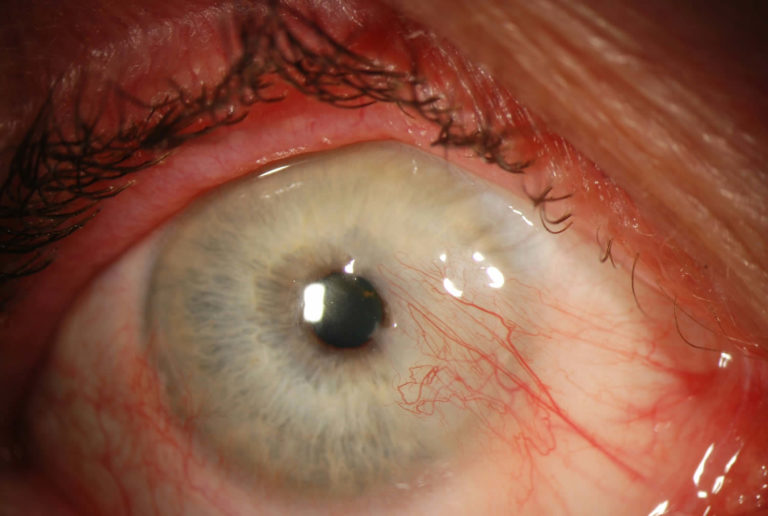 Pinguecula eye causes, symptoms, diagnosis & pinguecula eye treatment