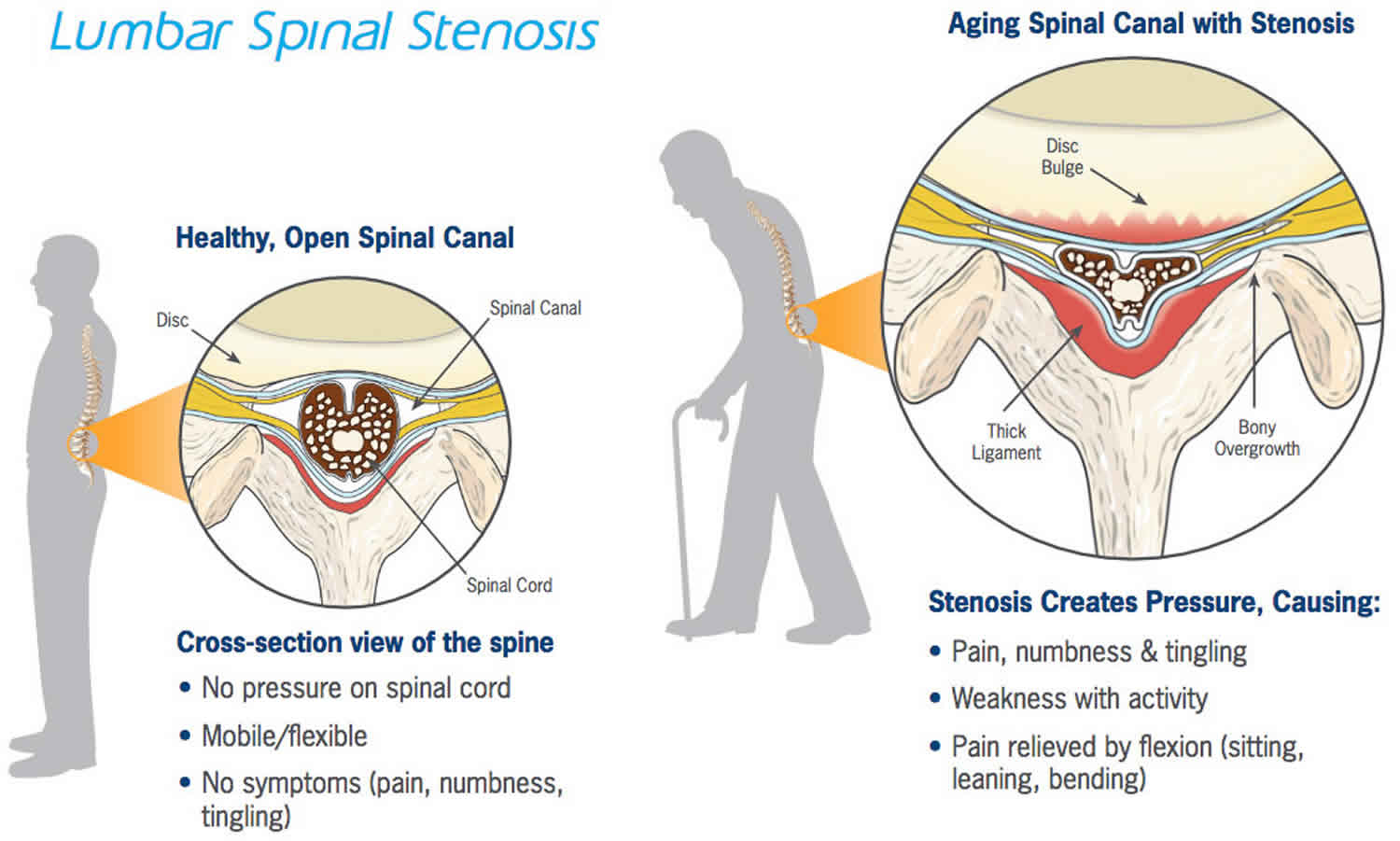 Spinal Stenosis Causes, Diagnosis & Management