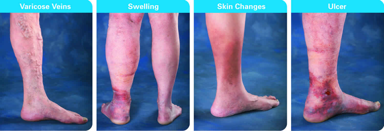 early stages of venous insufficiency