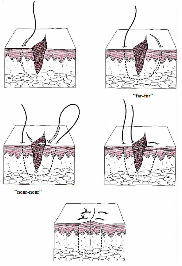 Surgical suture, types of sutures, sizes, how to suture & suture