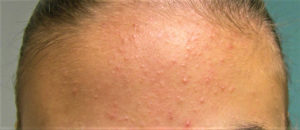 Whiteheads Causes, Find Out How To Get Rid Of Whiteheads