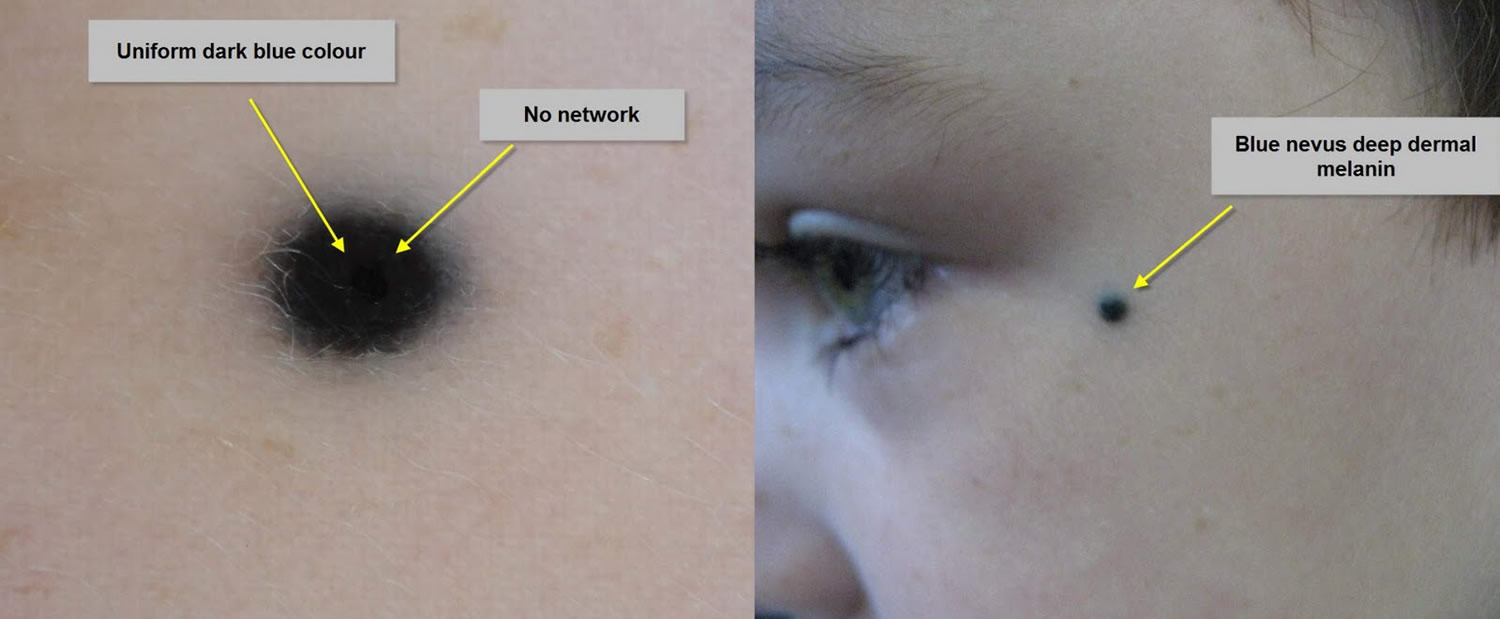 Nevus definition, types, diagnosis & nevus treatment