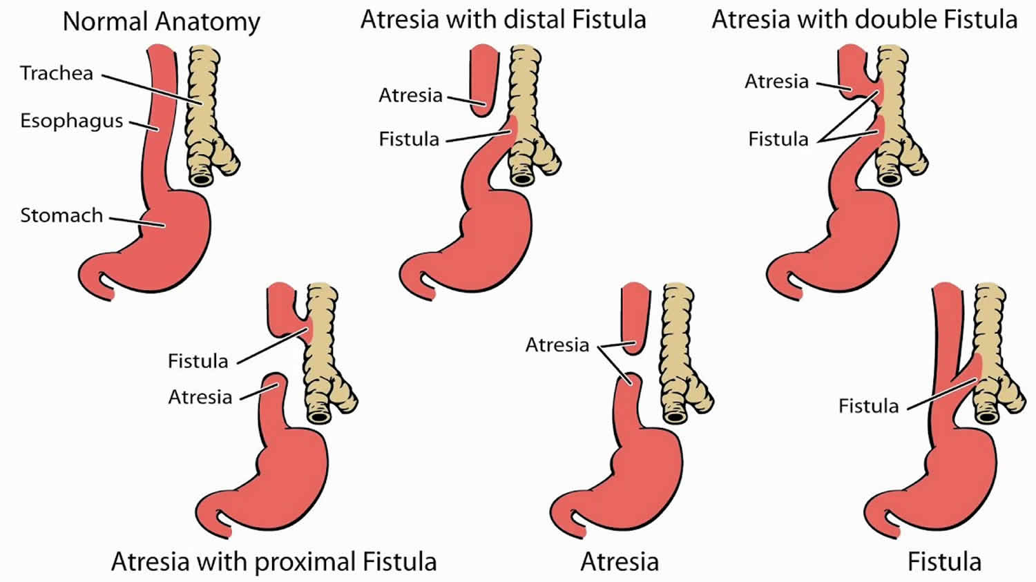 Esophageal Atresia And Tracheoesophageal Fistula Causes Symptoms And Treatment