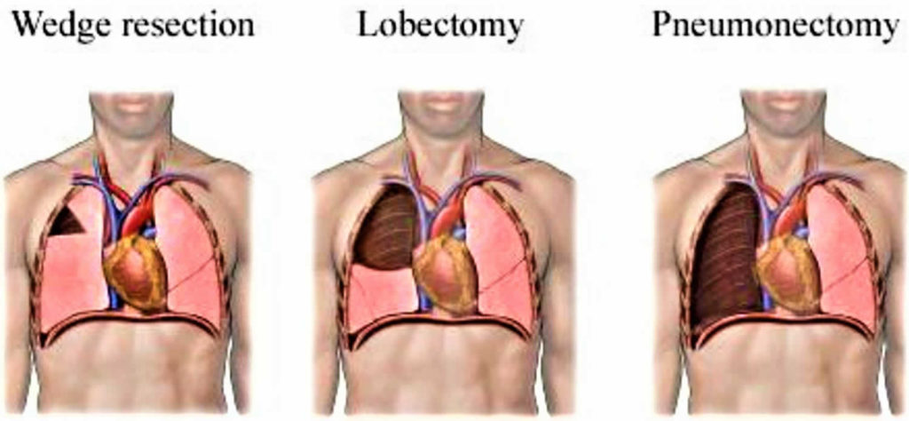 pneumonectomy-procedure-position-complications-and-revovery