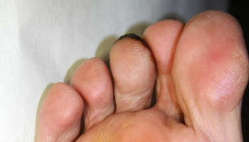 calluses on feet