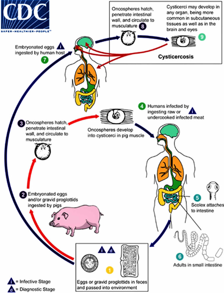 Cysticercosis Causes Prevention Symptoms Diagnosis And Treatment