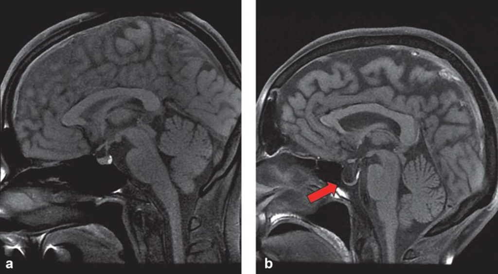 Empty Sella Syndrome Causes Risk Factors Symptoms Diagnosis And Treatment