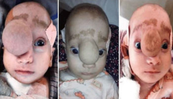 frontal encephalocele