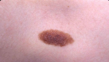 nevus