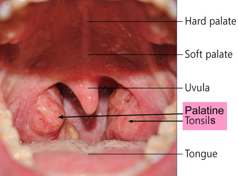 Are Tonsil Stones Causing Sore Throat